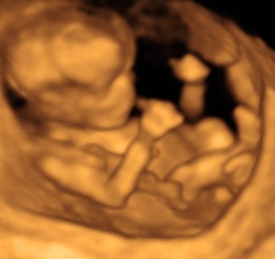 ultrasound