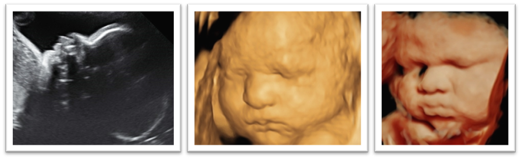 Packages 3D Ultrasound 4D Ultrasound Baby Impressions 4D Greenville SC.